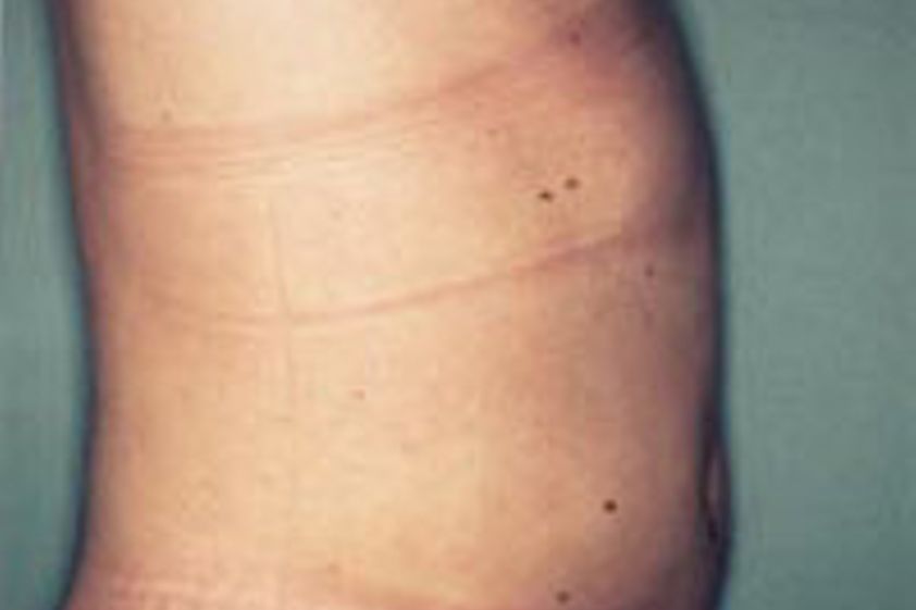 Ultraschall Fettabsaugung resultate - 777518