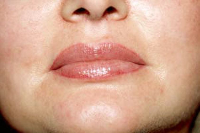 Lippenkorrektur resultate - 777523