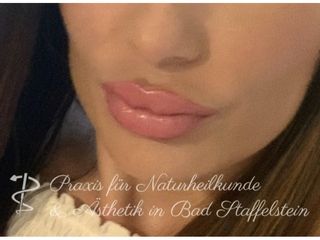 Lippenvergrößerung mit Hyaluronsäure - Nadine Löffler