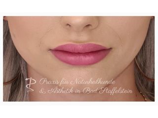 Lippenvergrößerung mit Hyaluronsäure - Nadine Löffler