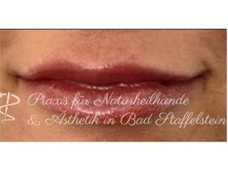 Lippenvergrößerung mit Hyaluronsäure - Nadine Löffler