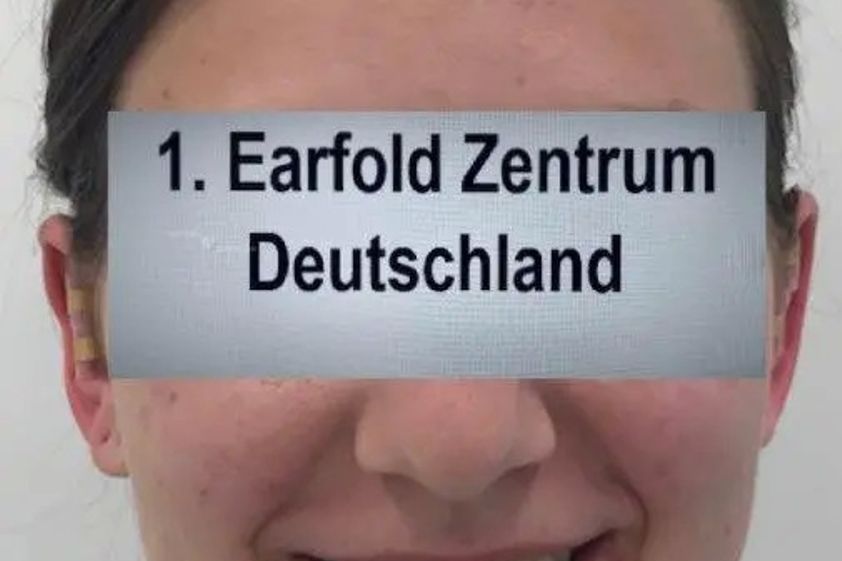 Otoplastik resultate - 785064