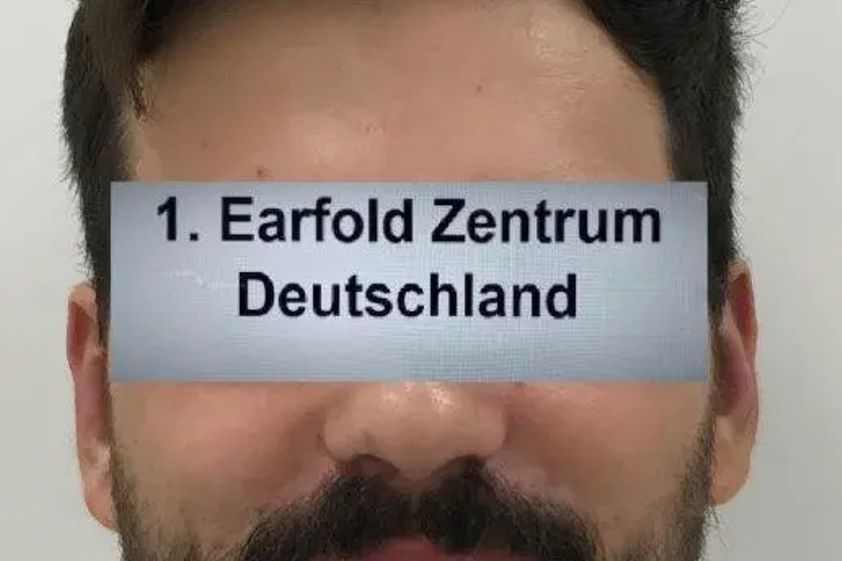 Otoplastik resultate - 785066