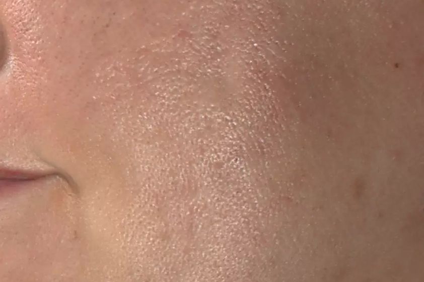 Narbenbeseitigung mit Laser resultate - 777347