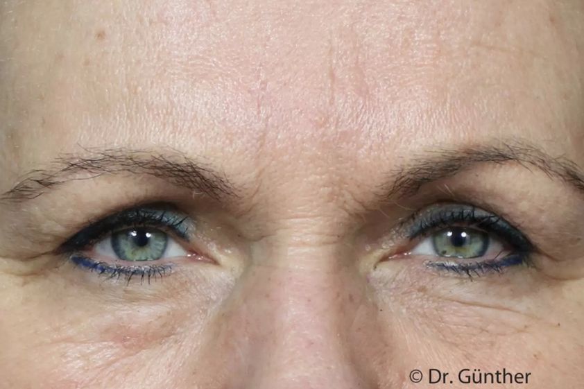 Botox resultate - 777349