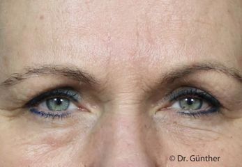 Botox-Behandlung der Zornesfalte