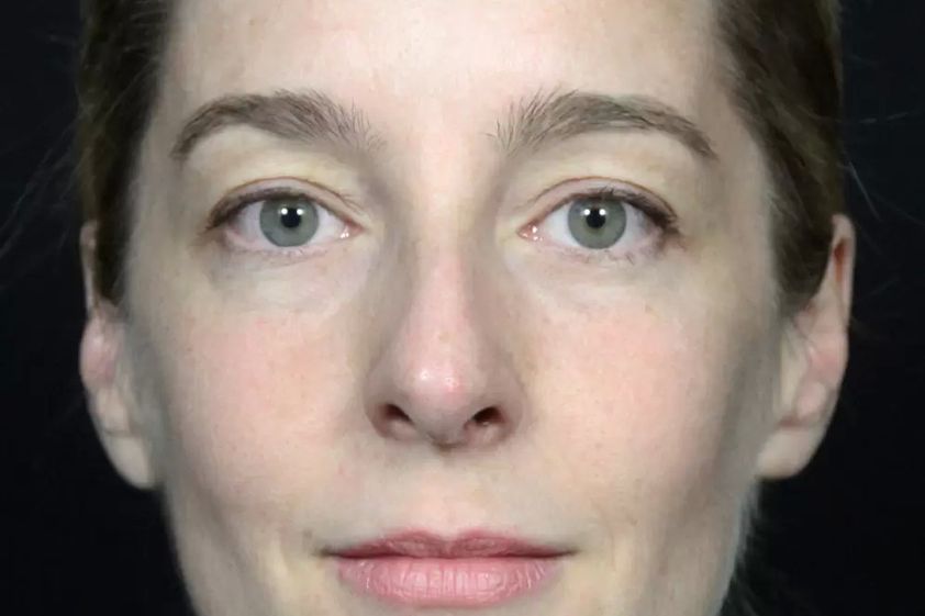 Laserbehandlung resultate - 777357