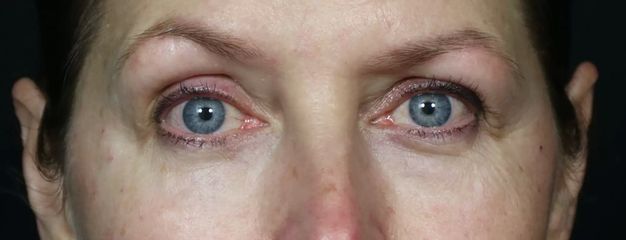 Juvederm gegen Augenringe / Tränenrinne