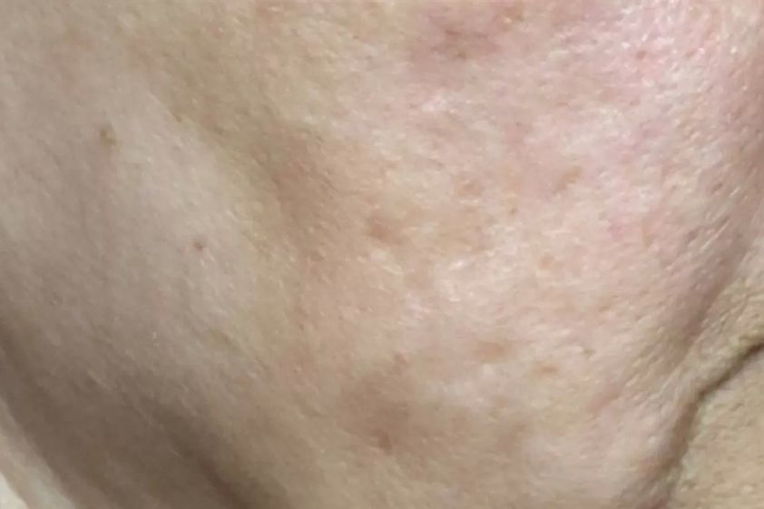 Narbenbeseitigung mit Laser resultate - 777363