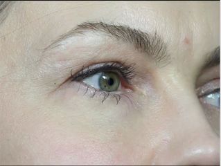 Juvederm gegen Tränenrinne