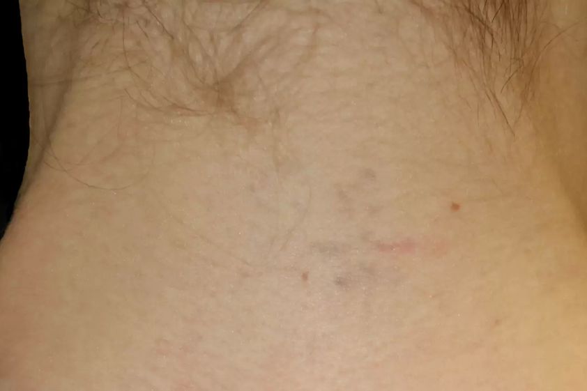 Laserbehandlung resultate - 777369