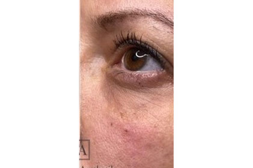 Augenringe entfernen resultate - 840444