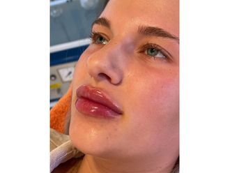Lippenvergrößerung mit Hyaluronsäure - 840452