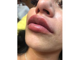 Lippenvergrößerung mit Hyaluronsäure - 840453