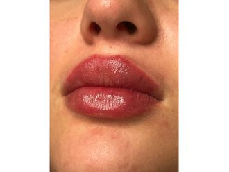 Lippenvergrößerung mit Hyaluronsäure - 840454