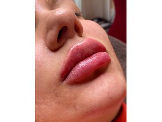 Lippenvergrößerung mit Hyaluronsäure - 840456