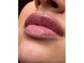Lippenvergrößerung mit Hyaluronsäure - 840457