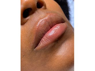 Lippenvergrößerung mit Hyaluronsäure - 840458