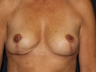 Brustimplantat entfernen resultate - 780397
