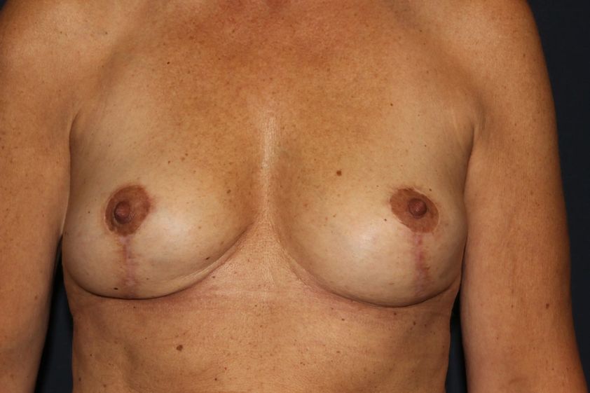 Brustimplantat entfernen resultate - 780397