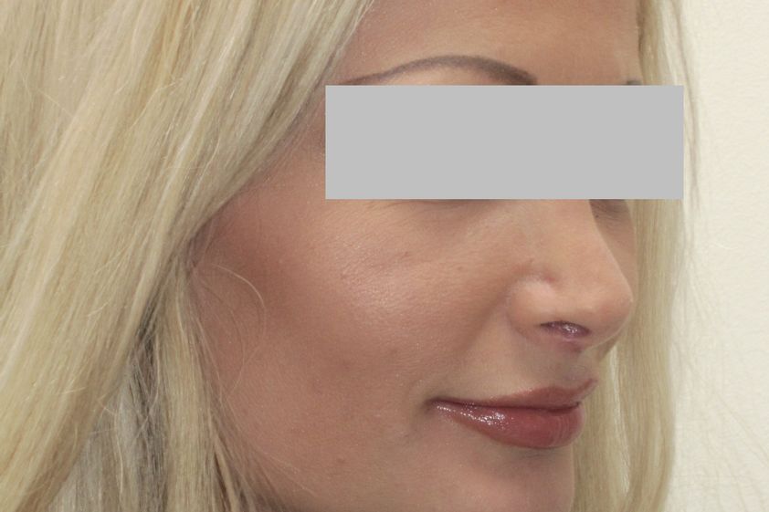 Lippenlifting resultate - 821833