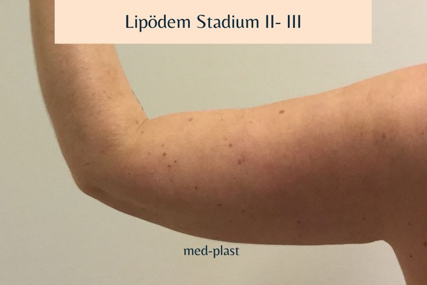 Lipödem resultate - 821472