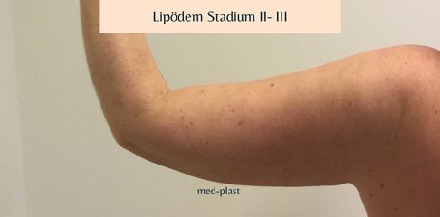 Lipödem - med-plast Berlin