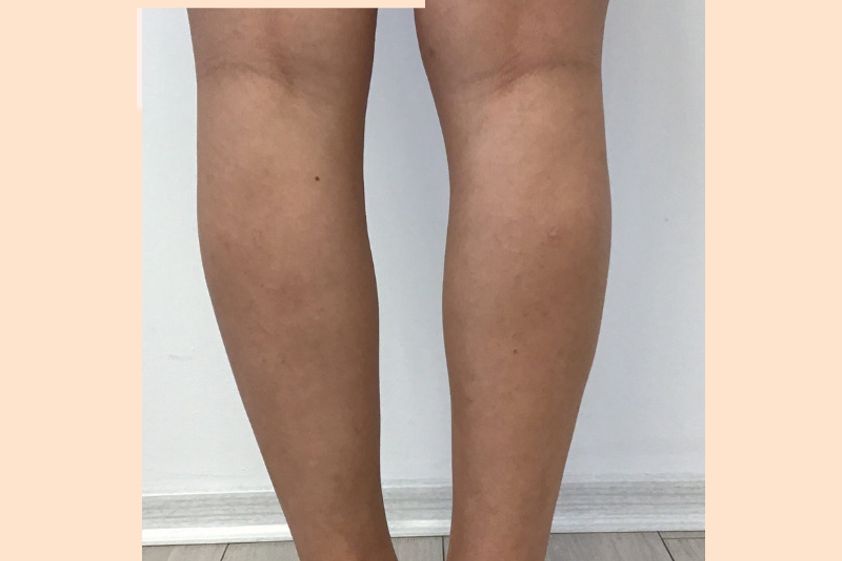 Lipödem resultate - 821474