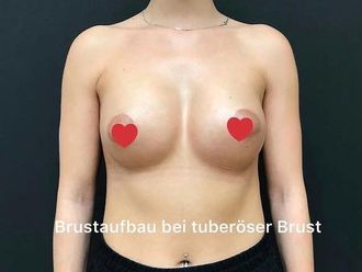 Brustvergrößerung resultate - 880310