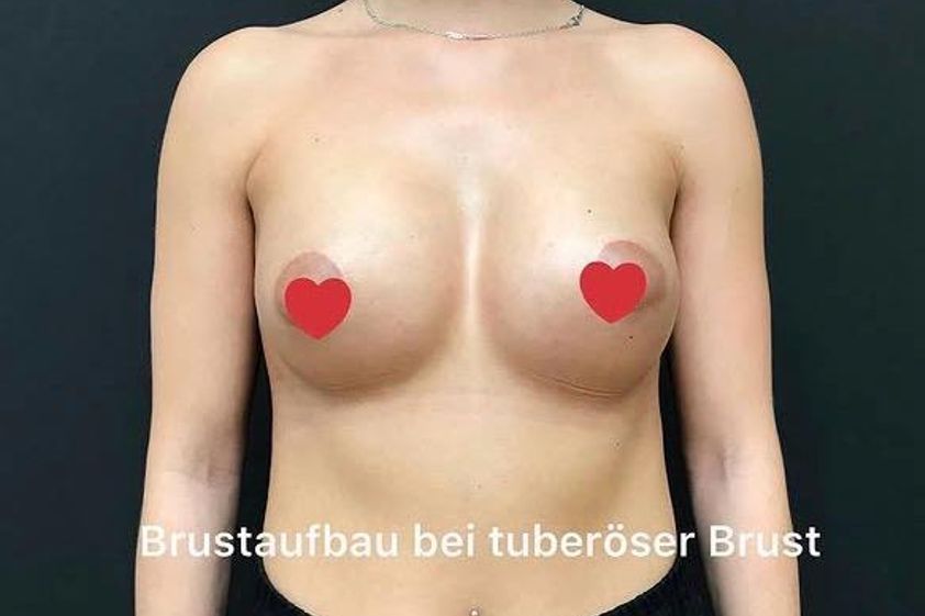 Brustvergrößerung resultate - 880310