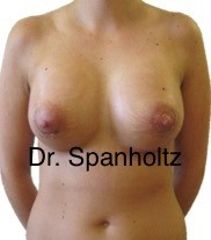 Ergebnis einer Brustvergrößerung mit Implantat - Dr. Timo Spanholtz