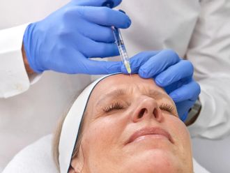 Botox resultate - 881273