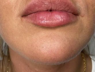 Lippen aufspritzen - 868274