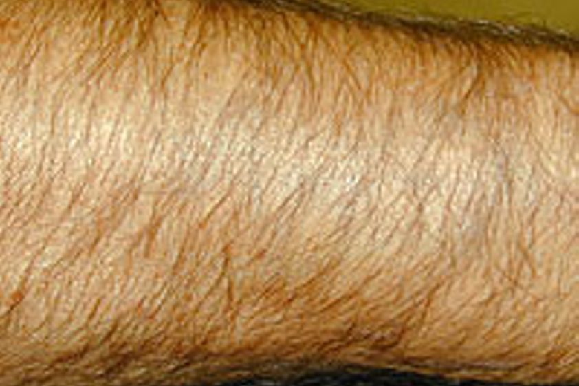 Tattooentfernung resultate - 777849