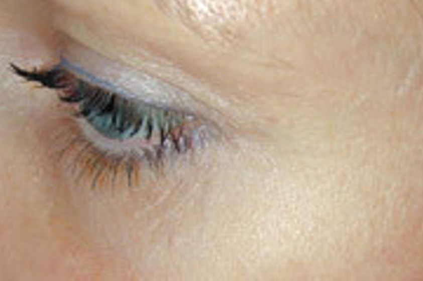 Botox resultate - 777855