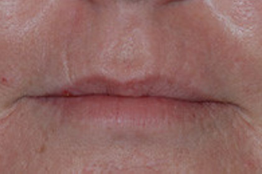 Mikrodermabrasion resultate - 777856