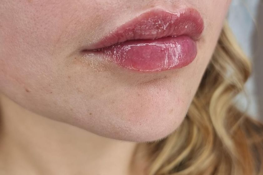 Lippen aufspritzen resultate - 850706