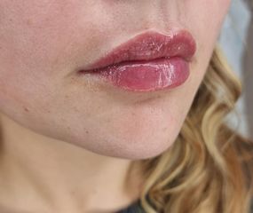 Lippen aufspritzen - ReVital Aesthetic GmbH