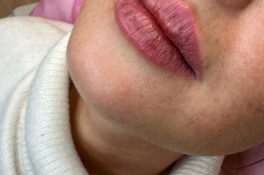 Lippen aufspritzen resultate - 850708
