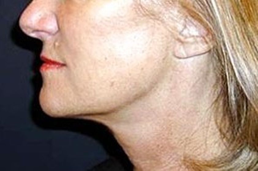 Facelift resultate - 779144