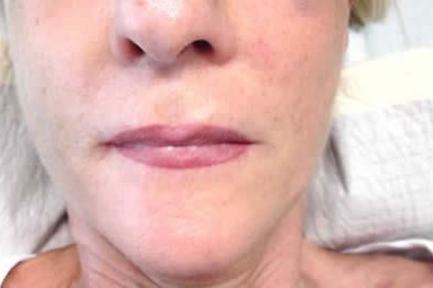 Lipofilling resultate - 781260