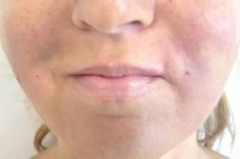 Lipofilling resultate - 781263