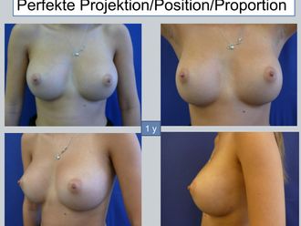 Brustvergrößerung resultate - 880392