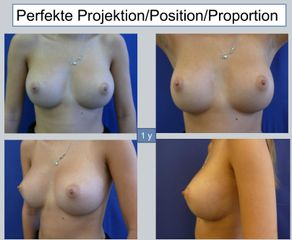1 Jahr postoperativ: Projektion, Position und Proportion
