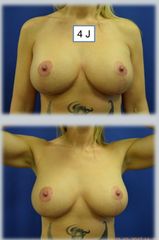 4 Jahre postoperativ: Bruststraffung mit Implantat