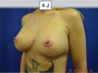 Bruststraffung resultate - 880394