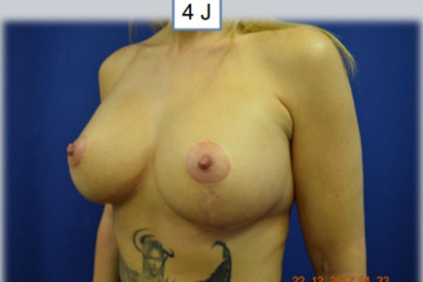 Bruststraffung resultate - 880394