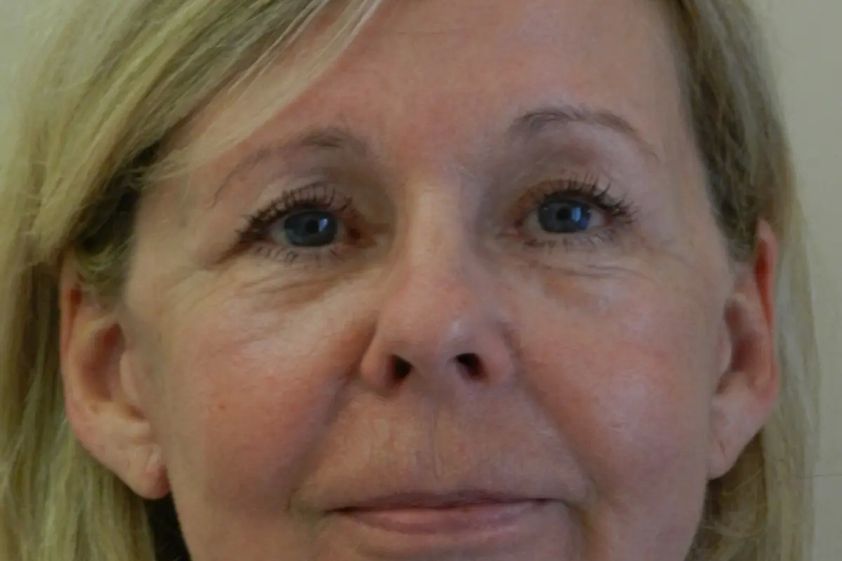 Facelift resultate - 780310