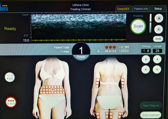 Straffung am Körper ohne OP mit 3D-HIFU der neuen Generation