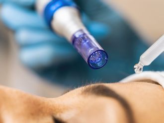 Microneedling resultate - 877303